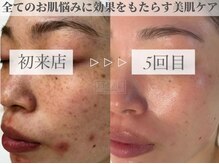 エリス(ELISSE)/お肌の汚れを取り除くことが大事