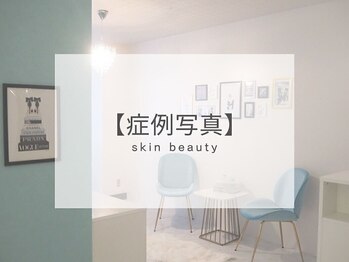 ベル 原宿(Belle)/ハーブピーリング｜ニキビケア