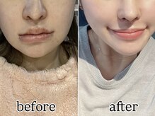 術後インディバ専門サロン 新宿の雰囲気(《輪郭/ビフォーアフター》術後インディバ/ダウンタイム短縮)