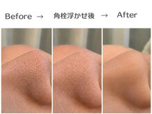 エスポワール(espoir)/専用の美容液で角栓を浮かし除去