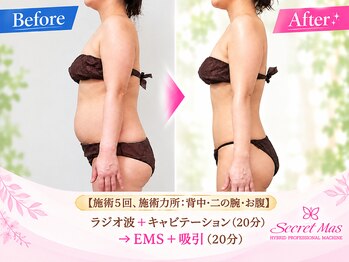 ロージュ 岐阜茜部サロン(Loge)の写真/痩身効果はマシンで決まる◎1つのハンドルで"ラジオ波"と"キャビテーション"が同時にできる最高峰マシン♪
