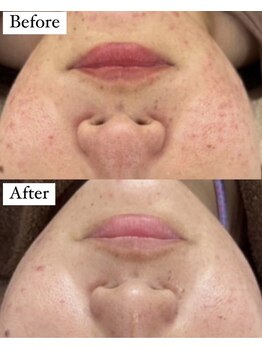 シエル 美里店(ciel)/Revi☆陶肌トリートメント