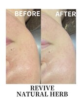 ハナ(HANA)/ハーブトリートメント