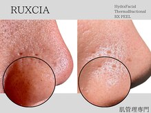 ルクシア(RUXCIA)/ビフォーアフター