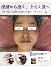 ユフラ(Juhla)/切らない小顔リフト