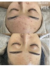 ミセル(MISEL2nd)/ニキビケアもお任せ♪ピーリング