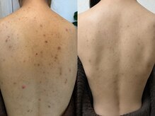 ピリナ 名古屋の雰囲気（背中ハーブピーリングで最短3ヶ月で結果出し◎リンパ付きも人気!）