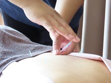 リファイン 南千住店(Re:Fine)の雰囲気（鍼で身体の調子を整えます。）