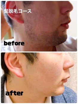 ビジュク(B-juku)/メンズ髭（ビフォーアフター）