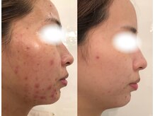 アネル 美里店(anel)/目的別韓国発”水光ピーリング”