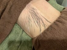 上野毛駅前整骨院 鍼灸院/鍼