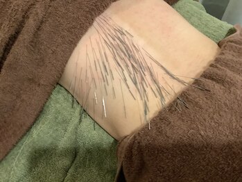 上野毛駅前整骨院 鍼灸院/鍼