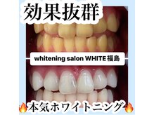ホワイトニングサロン ホワイト(WHITE)/セルフホワイトニング/大阪/福島