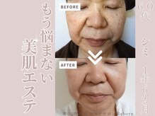 リボーン(Reborn)/６０代　シミケア(1年6ヶ月)