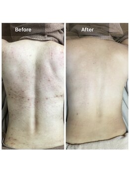 モカ 天王寺店(MOKA)/背中　ハーブピーリング　くすみ