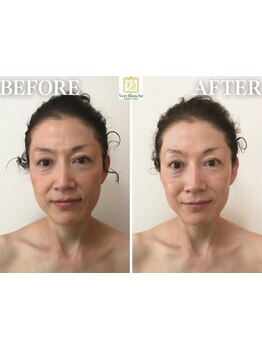 ホウレイ線・たるみ改善！予防ケア