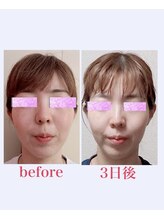 ブロッサム 山内店/フェイスリリース★効果写真