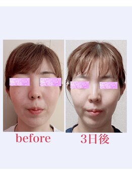 ブロッサム 山内店/フェイスリリース★効果写真