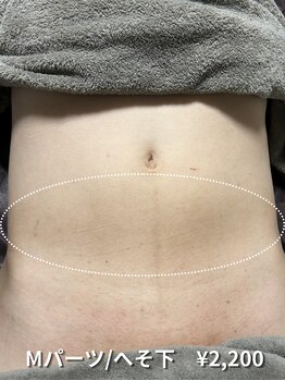 カナウ(KANAU)/【Mパーツ/脱毛】へそ下