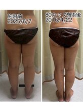 クールスパ(COOL SPA)/50代女性 脚症例
