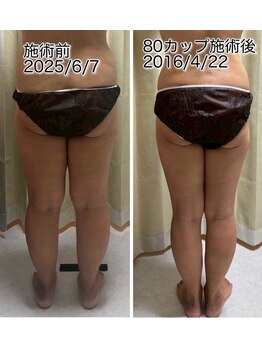 クールスパ(COOL SPA)/50代女性 脚症例