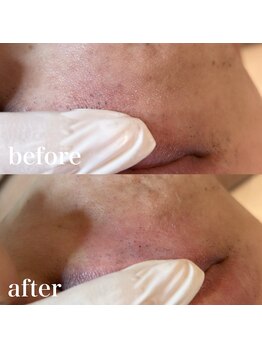 ニコ(Nico)/毛穴エクストラクション