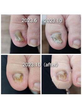 爪切り屋 足楽/肥厚爪