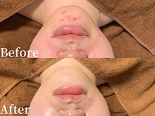 プレジール(plasir)/ニキビケアお任せ下さい！