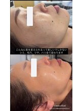 クリエイト(Create)/肌質改善オーダーメイド施術