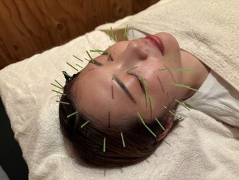 いまふく治療院の写真/【美容鍼】お顔のシワやくすみを改善して、スッキリ小顔に！お肌のターンオーバーを早めて肌質の改善にも◎