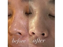 1回でここまで変わる毛穴改善シミ・毛穴・くすみに圧倒的変化！