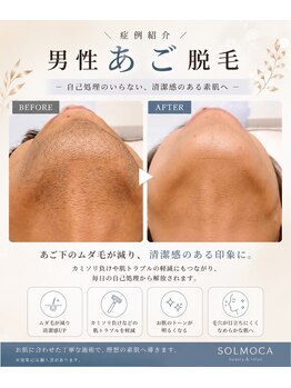 ソルモカ(SOLMOCA)の写真/営業・接客業の方必見！毛穴詰まりを解消して清潔感ある好印象な肌へ◇通いやすい立地と価格で継続ケアも◎