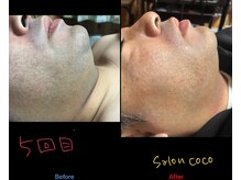 サロン ココ(COCO)/ヒゲ脱毛　5回目