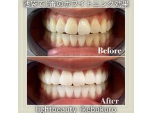 ライトビューティー 池袋店(LightBeauty)/症例写真
