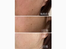 ケリー 名古屋(Kelly)の雰囲気（ダウンタイムなしの全顔シミケア♪濃いシミケア、薄いシミケア）
