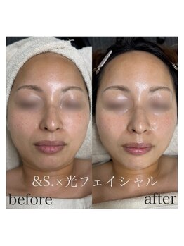 アンドエス(&S.)/多幸感♪光フェイシャル☆