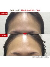 リンク 錦糸町店(Link)/40歳！1ヶ月で額の毛穴改善！