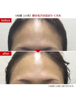 リンク 錦糸町店(Link)/40歳！1ヶ月で額の毛穴改善！