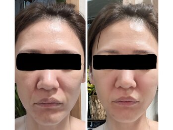 ラグーン(Lagoon)/WINBACK×小顔矯正コルギ