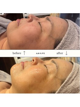 ビーエヌ エステティックアンドスパ(BN Esthetic&Spa)/60代ムルトクス