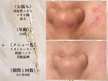 アクール(Accueil)/【ニキビ・毛穴】