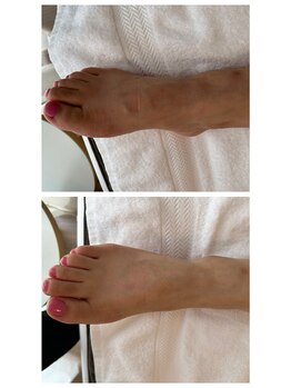 グリッタープラス(glitter plus)/フットトリートメントもおすすめ