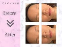 リライフ(ReLIFE)/韓国肌管理/毛穴洗浄+ララピール