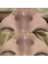 アミュレット(amulette)/1回で実感！毛穴レス♪