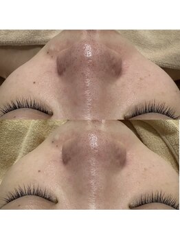 アミュレット(amulette)/1回で実感！毛穴レス♪