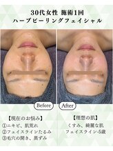 シーフェイス 横浜店(SEE FACE)/30代ハーブピーリングモニター