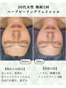 シーフェイス 横浜店(SEE FACE)/30代ハーブピーリングモニター