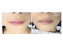 ニコ(nico)/産毛もヒゲにも幅広い毛に◎