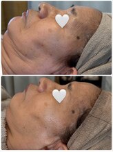 エム(M)/NDピーリング＆石膏パック