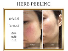 ロージー(ROSY)/ハーブピーリング/阿南/徳島